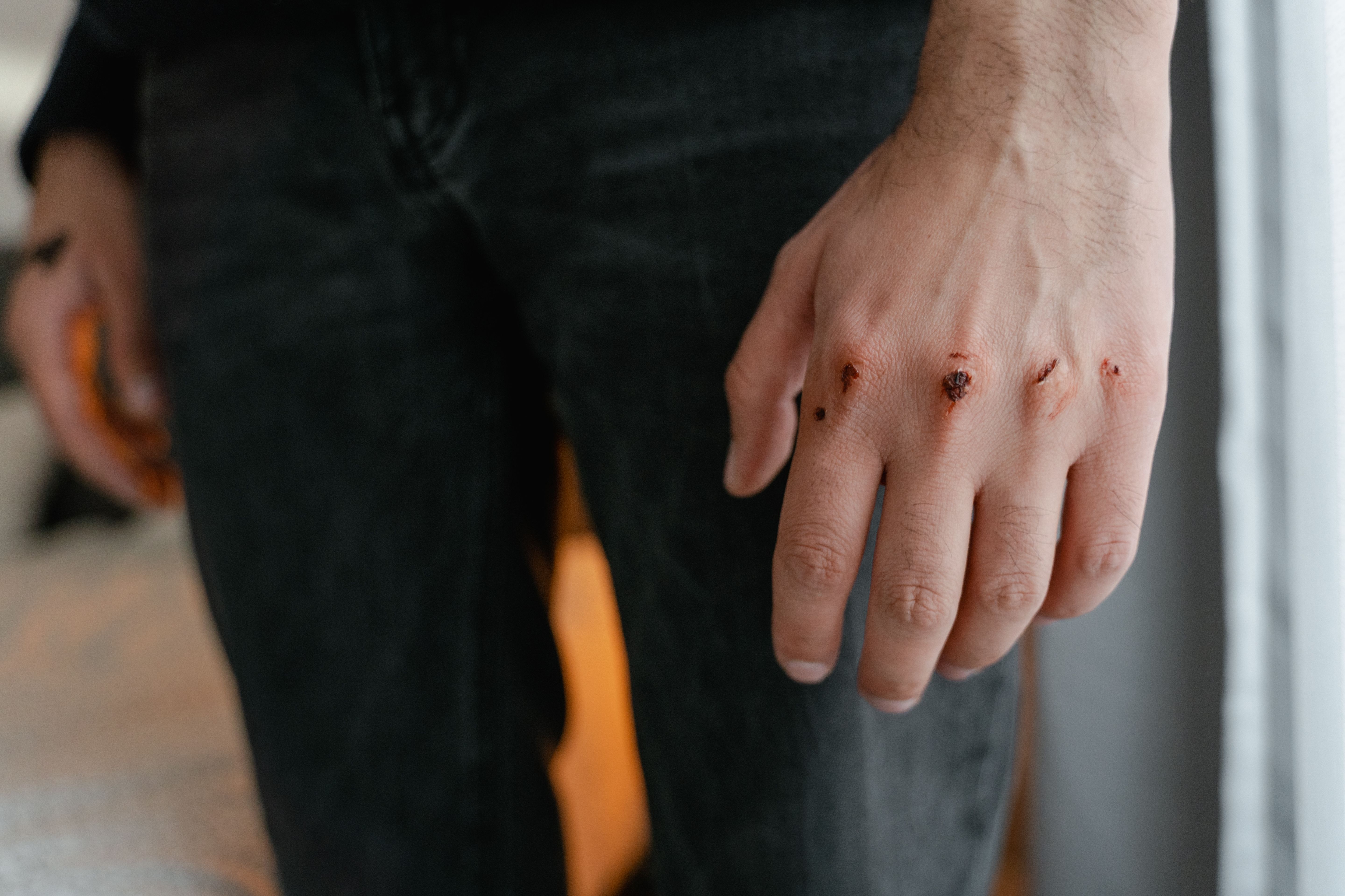Close-up of a person's hand with wounds and scratches from a dog bite injury